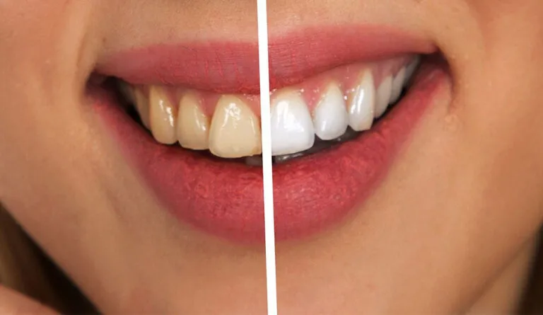 Salvia per sbiancare i denti: funziona davvero?