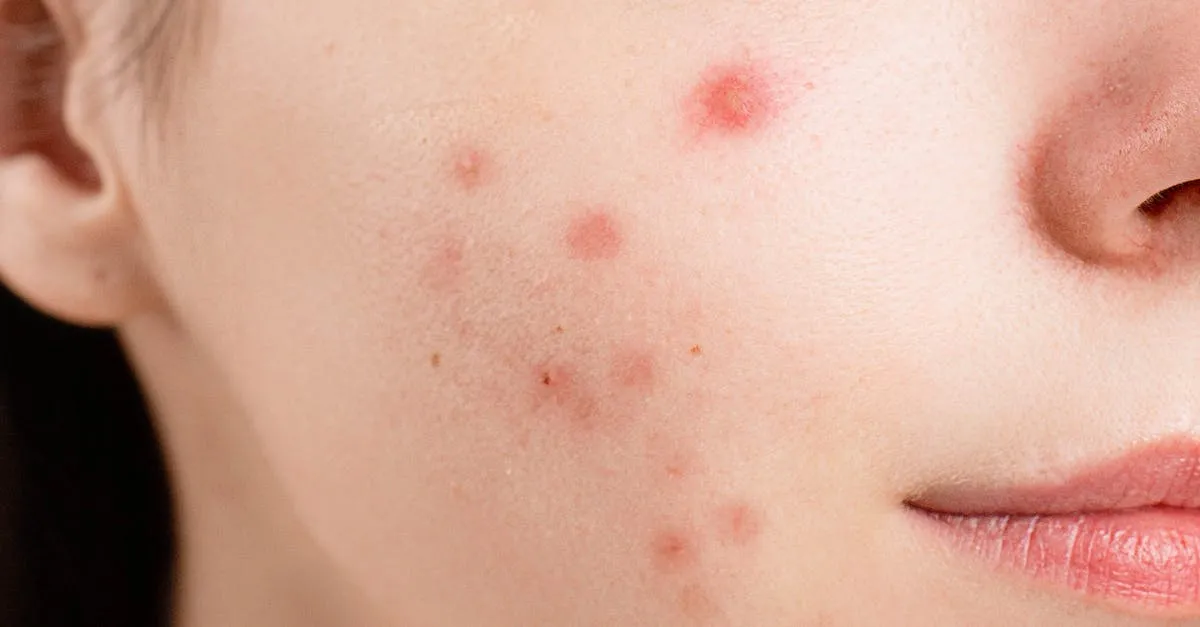 Cura dell’acne: Strategie efficaci per una pelle radiosa
